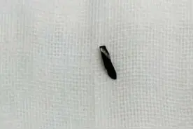 险！东莞一装修工人眼内飞入电钻头图片