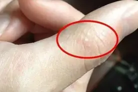 姑娘手指长满小水泡，医生：这症状夏天高发图片