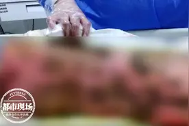6岁女孩连续高烧3天后，突然全身脱皮，命悬一线！图片