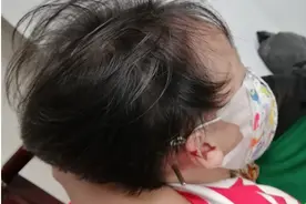 家里玩耍不慎摔倒，螺丝刀插入2岁女孩颅脑图片