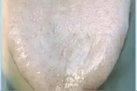 身体好不好，看舌头就知道！有这类舌象的人一定要注意了图片