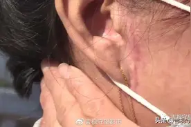 好姐妹组团做“拉皮”，术后伤疤一个比一个大...图片
