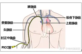 直肠癌治疗历程（四）图片