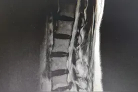 你是椎间盘膨出？椎间盘突出？还是椎间盘脱出？图片