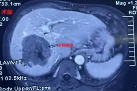 【患者福音】直肠癌术后肝转移！这次她在绝望中找到希望！图片