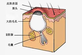 黑头是怎么形成的？又要怎样去除呢？图片