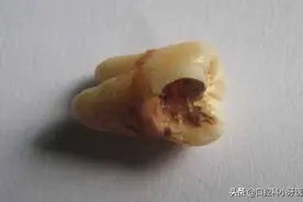 好好的智齿为什么拔了？并且价格比拔其它牙齿贵，听听医生解释！图片