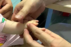 多指宝宝手术切除哪根手指比较好？切除后还会长出来吗？图片