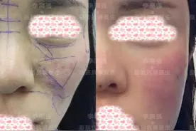 患者分享｜用自体脂肪填充面部后，我终于摆脱苦相脸，秒变少女颜图片