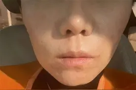 济南女子花2万多元整容后，越看自己越“奇怪”：眼睛“倒三角”下巴歪斜，看起来又凶又老图片