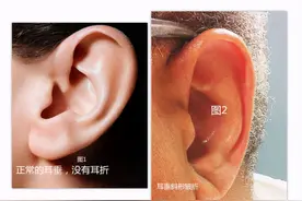 耳朵上有这条折痕，是心梗、猝死的“标志”？专家：不能划等号图片