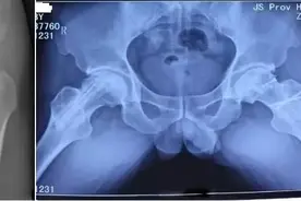 股骨头坏死一定要手术置换吗？图片