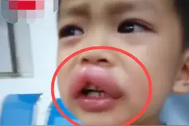 4岁男童“嘟嘟嘴”，亲爸心疼又好笑，孩子食物过敏不容忽视图片