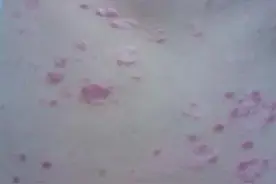 牛皮癣好转的信号有哪些？不了解一下怎么知道自己是不是快好了图片