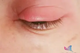 可怕！一男子吃火锅后险些致盲，罪魁祸首竟是眼皮上的"痘痘"…图片