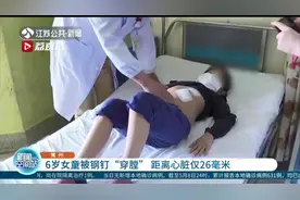 太危险！6岁女童被钢钉“穿膛”距离心脏仅26毫米图片