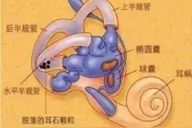 关于“耳石症”，你知多少？图片