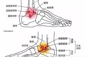 有人，为什么总是崴脚？如何保护？请对照自查保足踝健康图片