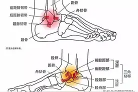 有人，为什么总是崴脚？如何保护？请对照自查保足踝健康图片
