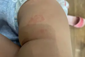 从宝妈亲身经历的角度，让我来告诉你宝宝过敏该怎么处理？图片