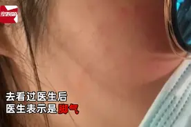 脸上还会长脚气？女子脸上长红痘想不通来由，一翻视频自己秒懂图片