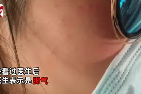 脸上还会长脚气？女子脸上长红痘想不通来由，一翻视频自己秒懂图片