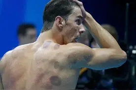 这届老外，终于知道拔罐的秘密了？图片