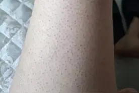 新手去鸡皮方法！皮肤一天比一天滑溜图片