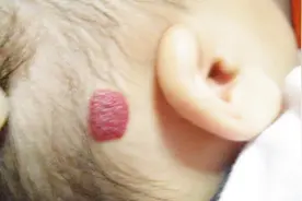血管瘤怎么形成的？和哪些因素有关？视频封面
