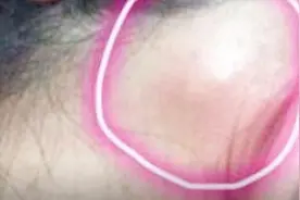 耳朵后面长硬包是什么回事？专家：要警惕这4种问题视频封面