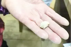 大妈一阵咳嗽喷出一块石头 医生却说她好幸运视频封面