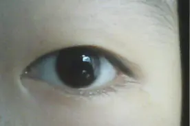 内双的妹子可以割双眼皮吗？有没有效果呢？视频封面