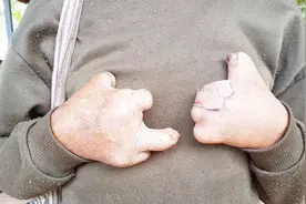 皮肤结核病的早期症状？皮肤结核病有哪些表现？视频封面