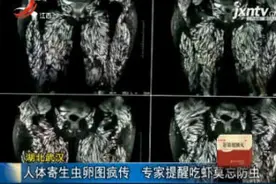 湖北武汉：人体寄生虫卵图疯传 专家提醒吃虾莫忘防虫视频封面
