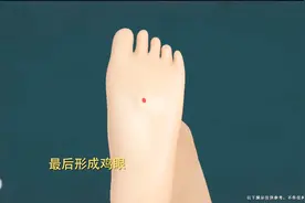 一朝得鸡眼，让我日子苦不堪言啊！到底怎么回事？3D演示鸡眼形成视频封面