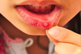 口腔溃疡怎么办？经常吃这几种水果，口腔溃疡不再犯！视频封面