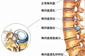 腰疼千万不能拖！多做这3种运动，告别腰间盘突出！视频封面
