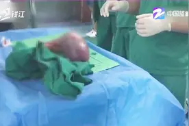 540斤小伙“切胃”减肥，术前胃部比常人大一倍视频封面