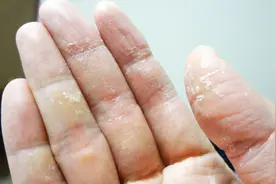 每年夏天手上都出现小水泡很痒，3个小妙招能去除，效果还不错视频封面