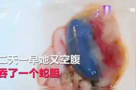 女子为治红疹生吞蛇胆，致中毒紧急住院视频封面