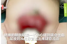万幸！新生女婴罕见膀胱外翻，医生抢在72小时黄金时间完成手术！视频封面