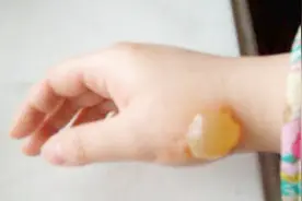 不小心烫伤怎么办，教你自己在家这样应对，不仅快速止痛还不留疤视频封面
