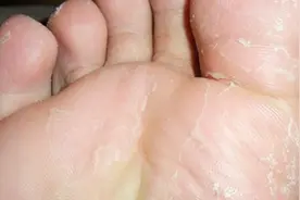 郭姐小妙招；脚老爱出汗，奇痒难受，教你一招，轻松止痒视频封面