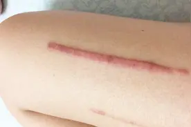 皮肤受伤了怕留下疤痕？只需一点青草膏和体乳，恢复后永久无疤痕视频封面