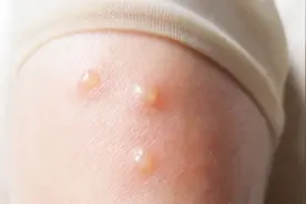 夏天手上起小水泡，可不要挠，简单一招就能去除，效果太棒啦视频封面