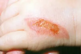 不小心被烫伤怎么办？教你一招，止痛快还不起泡，不留疤视频封面