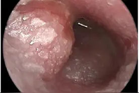 孩子耳朵流脓导致面瘫该怎么办图片