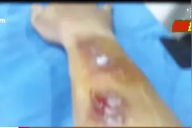 触目惊心！男子右手被腐蚀蛀出空洞 竟是划伤指甲被细菌感染所致视频封面