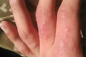 手上长水泡别着急，老中医教我1招，简单有效视频封面