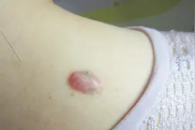 什么是瘢痕体质？专家为你解答视频封面